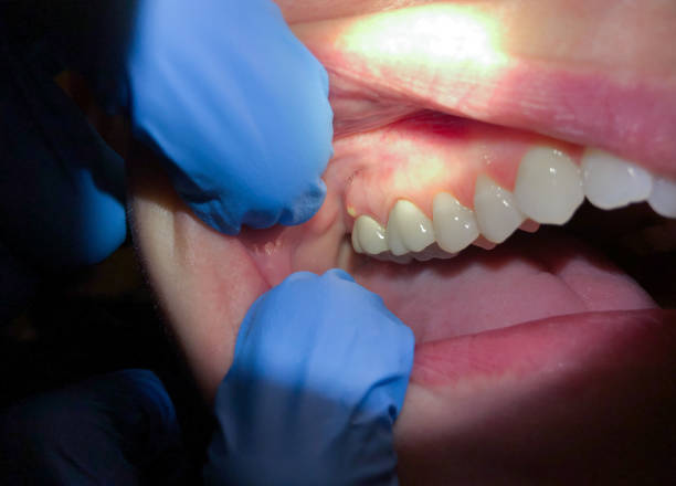 Best Emergency Dentist for Lost Fillings or Crowns in Lanham, MD